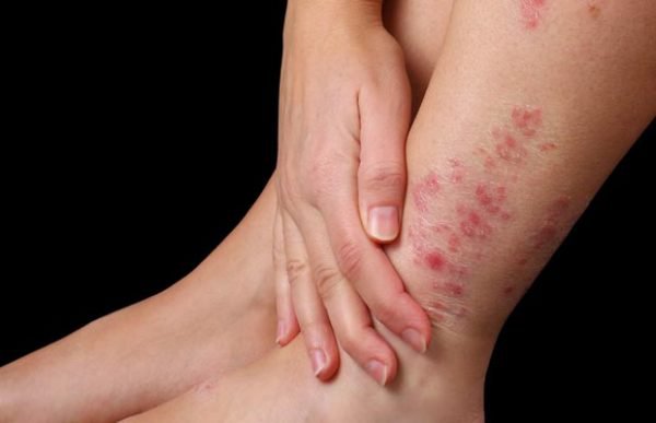 Viêm da cơ địa có thể gây ngứa ngáy, khó chịu và đau đớn cho người bệnh