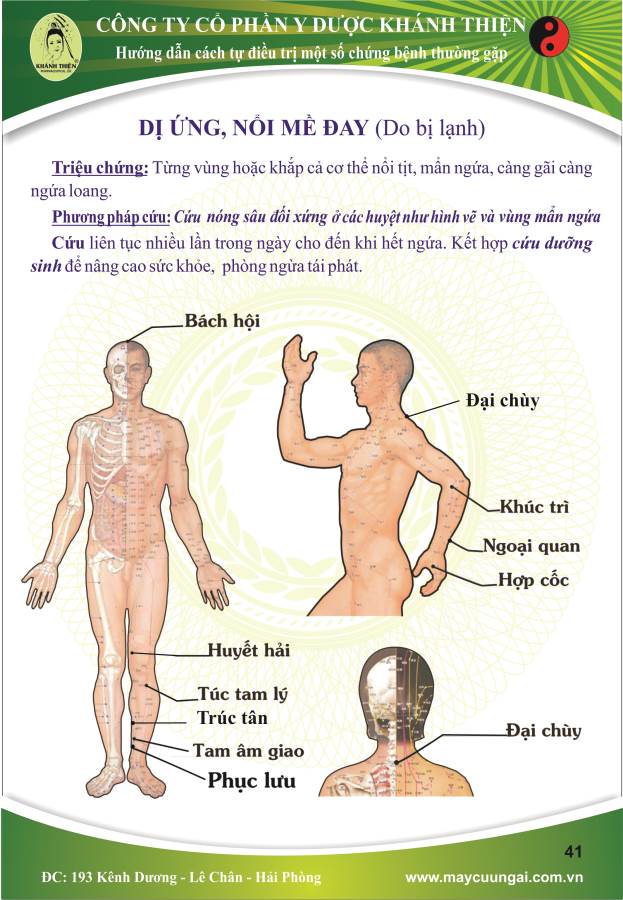 Máy cứu ngải: Cứu nổi mề đay ( do bị lạnh )