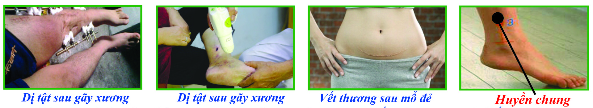 CHẤN THƯƠNG – DỊ TẬT DO GÃY XƯƠNG – VẾT MỔ SAU LIỀN